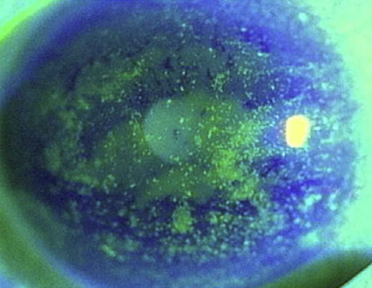 Visual acuity and quality of life in dry eye disease: Proceedings of the OCEAN group meeting