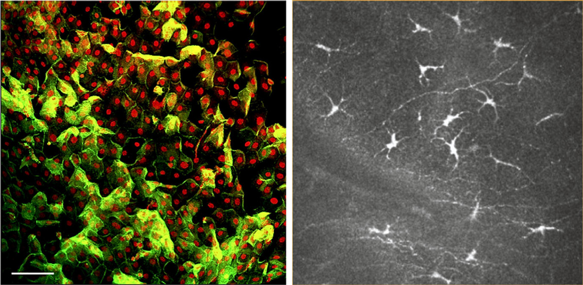 Clinical impact of inflammation in dry eye disease: proceedings of the ODISSEY group meeting