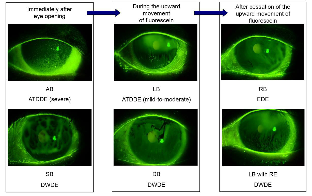 Defining Dry Eye from a Clinical Perspective